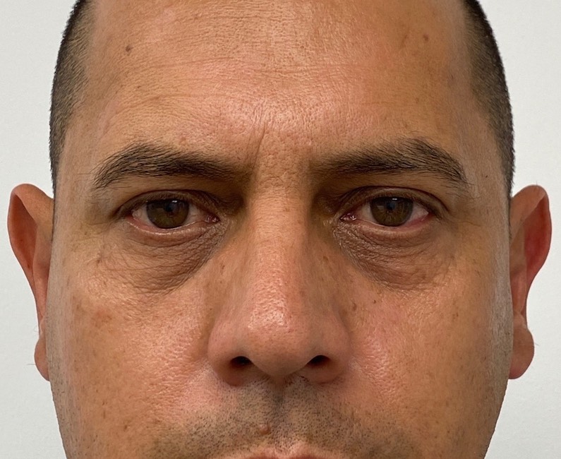 Under Eye Fillers Before & After Patient #2016