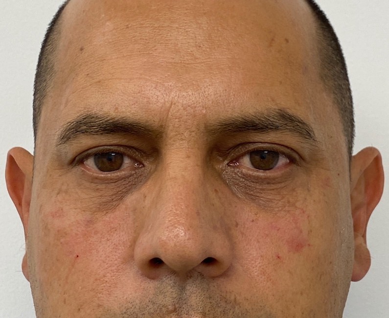 Under Eye Fillers Before & After Patient #2016