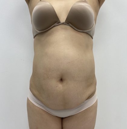 Liposculpture Before & After Patient #2021