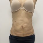 Liposculpture Before & After Patient #2021