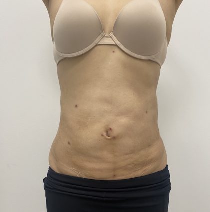 Liposculpture Before & After Patient #2021