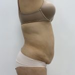 Liposculpture Before & After Patient #2021