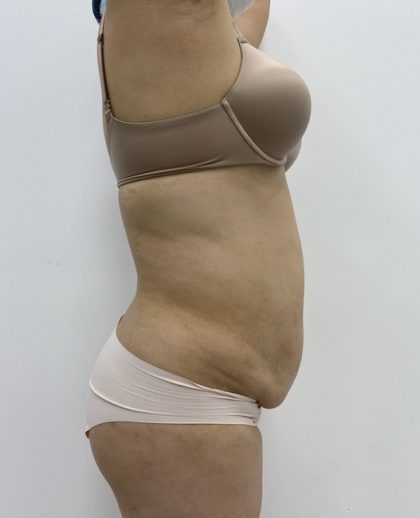 Liposculpture Before & After Patient #2021