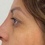 Non-Surgical Rhinoplasty Before & After Patient #2044