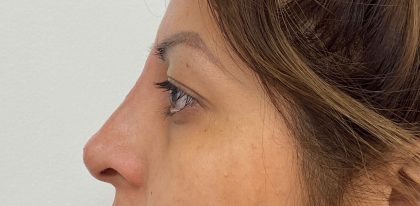 Non-Surgical Rhinoplasty Before & After Patient #2044