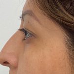 Non-Surgical Rhinoplasty Before & After Patient #2044