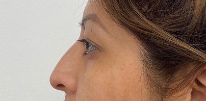 Non-Surgical Rhinoplasty Before & After Patient #2044