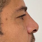 Non-Surgical Rhinoplasty Before & After Patient #2047
