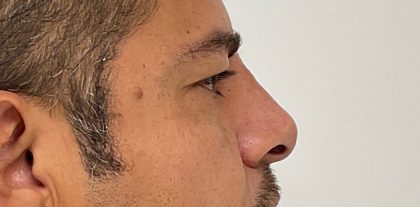 Non-Surgical Rhinoplasty Before & After Patient #2047