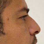 Non-Surgical Rhinoplasty Before & After Patient #2047