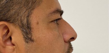 Non-Surgical Rhinoplasty Before & After Patient #2047