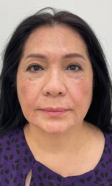 Facial Fillers Before & After Patient #2053