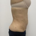 Liposculpture Before & After Patient #2021