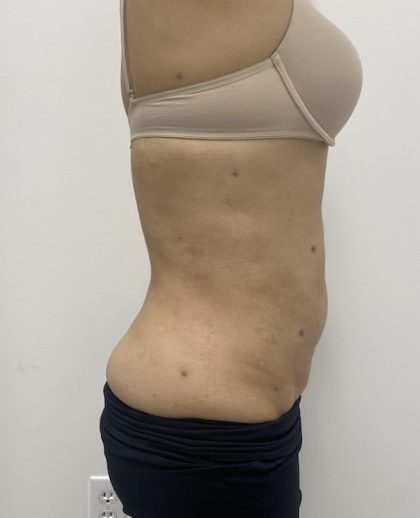 Liposculpture Before & After Patient #2021