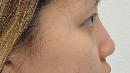 Non-Surgical Rhinoplasty Before & After Patient #2041