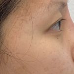 Non-Surgical Rhinoplasty Before & After Patient #2041