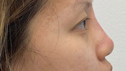 Non-Surgical Rhinoplasty Before & After Patient #2041