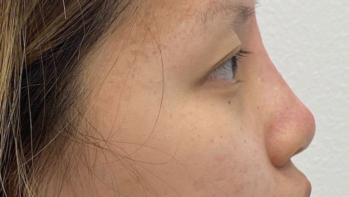 Non-Surgical Rhinoplasty Before & After Patient #2041