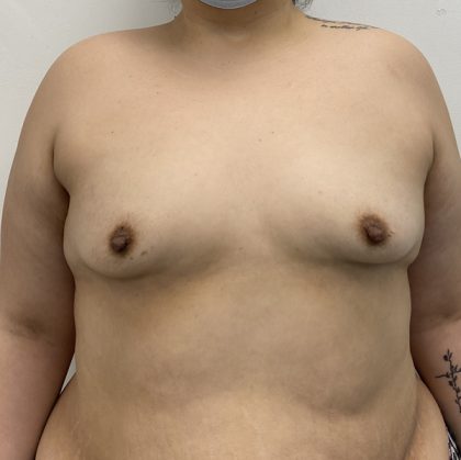 Breast Augmentation Before & After Patient #2113