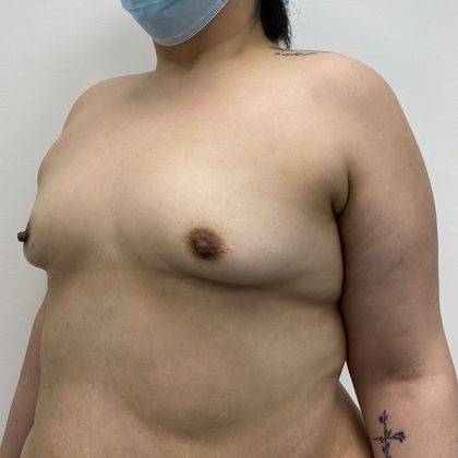Breast Augmentation Before & After Patient #2113