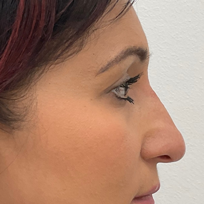 Rhinoplasty Before & After Patient #2139