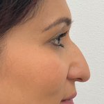 Rhinoplasty Before & After Patient #2139