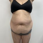 Liposculpture Before & After Patient #2159