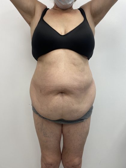 Liposculpture Before & After Patient #2159