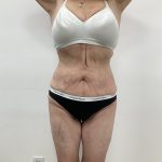 Liposculpture Before & After Patient #2159