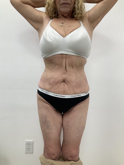 Liposculpture Before & After Patient #2159