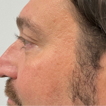 Non-Surgical Rhinoplasty Before & After Patient #2315