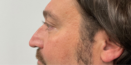 Non-Surgical Rhinoplasty Before & After Patient #2315