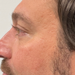 Non-Surgical Rhinoplasty Before & After Patient #2315