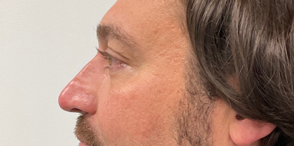 Non-Surgical Rhinoplasty Before & After Patient #2315