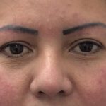Eye Lift Before & After Patient #2337