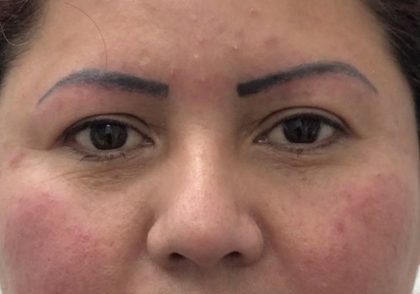 Eye Lift Before & After Patient #2337