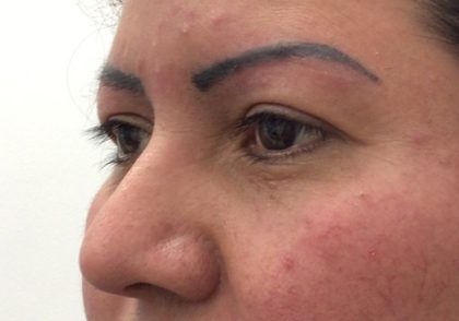 Eye Lift Before & After Patient #2337