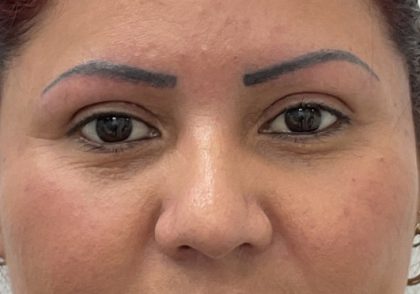 Eye Lift Before & After Patient #2337