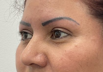 Eye Lift Before & After Patient #2337