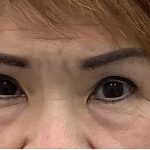 Lower Blepharoplasty Before & After Patient #2452