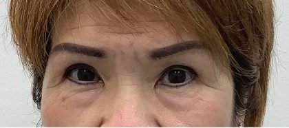 Lower Blepharoplasty Before & After Patient #2452