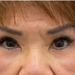 Lower Blepharoplasty Before & After Patient #2452