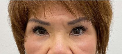 Lower Blepharoplasty Before & After Patient #2452