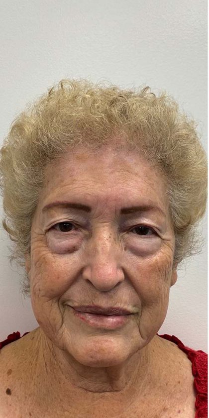 Lower Blepharoplasty Before & After Patient #2460