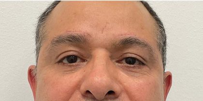 Brow Lift Before & After Patient #2455