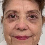 Lower Blepharoplasty Before & After Patient #2449