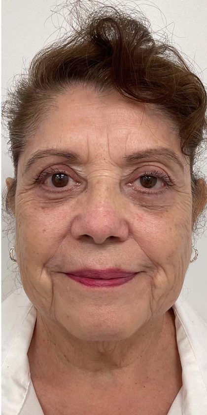 Lower Blepharoplasty Before & After Patient #2449