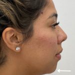 Chin Augmentation Before & After Patient #2488