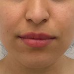 Lip Fillers Before & After Patient #2485