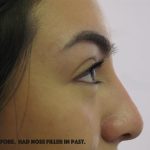 Facial Fillers Before & After Patient #2491